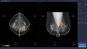 국내 업체의 AI 유방암 판독 연구 세계에 인정&hellip;루닛, 의학 학술지 '란셋 디지털 헬스'에 논문 게재