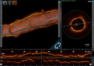 심장혈관 OCT, 정확한 병변 평가로 환자 안전 높인다