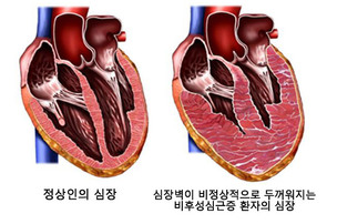 비후성심근증 환자, 심장초음파로 '심부전 위험' 예측 방법 찾았다