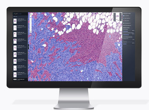 루닛, 암 치료에 AI 바이오마커 활용 가능성 확인&hellip;다양한 암종의 면역항암제 치료 효과 예측