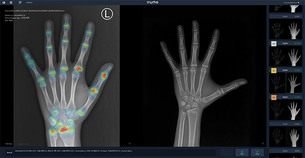 뷰노, AI 기반 '골 연령 판독 보조 솔루션'으로 대만 시장 진출 본격화