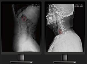 딥노이드, 척추 부위 의료영상 AI 솔루션 식약처 인증 획득