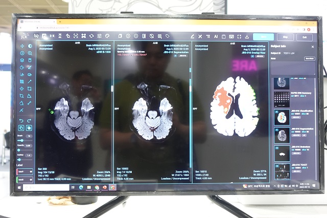 AI로 뇌경색 진단을 하는 솔루션 모습.