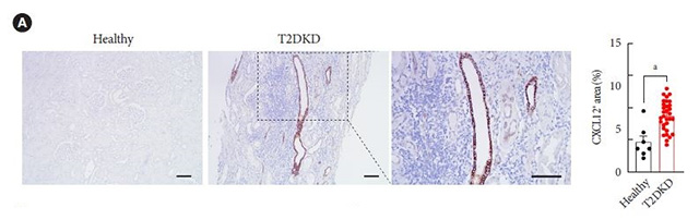 신장 염증 부르는 단백질? 국내 연구진, 당뇨병콩팥병 핵심 원인 규명