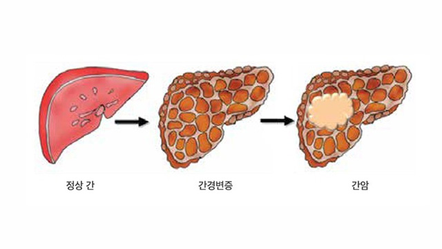 간암은 하루아침에 생기지 않는다…간의 단계별 변화