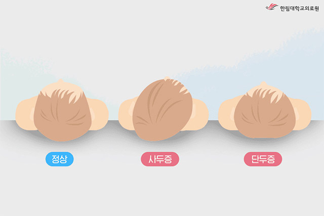 정상 두상과 자세형 사두증, 단두증의 형태 비교. 영아 두상 변형은 유형과 원인에 따라 경과와 대응 방식이 달라질 수 있다. /이미지=한림대학교동탄성심병원