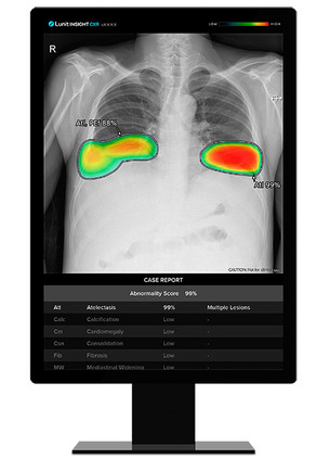 루닛, 브라질 종합병원에 흉부 엑스레이 AI 영상분석 솔루션 수출