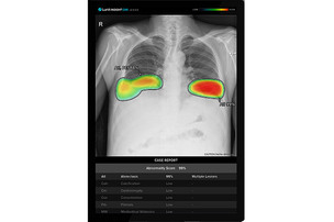 흉부 엑스레이 촬영 시 AI 활용, 폐 결절 검출률 2배 이상 높인다