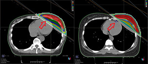 심장병 발생 위험 높은 왼쪽 유방암 방사선 치료, 부작용 줄이는 방법은?