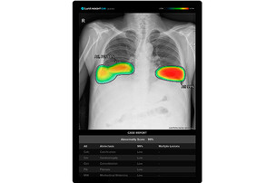 루닛, 아그파 제품에 흉부 엑스레이 AI 영상분석 솔루션 적용