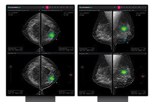 루닛, 3차원 유방암 검진 AI 솔루션 3월 말 유럽 판매 시작