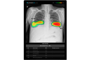 루닛, 해외 파병부대 등에 &#39;흉부 엑스레이 AI 영상분석 솔루션&#39; 공급 확대