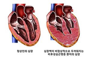 심장벽 두꺼워지는 '비후성심근증', 심장 수축 기능 정상이라도 합병증 위험 높다