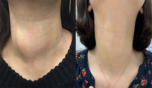 양성 갑상선 결절 ‘고주파 절제술’ 장기 치료 효과 확인…흉터 없고 안전성 높아