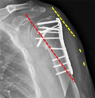 노인에 많은 어깨 상완골 골절, 최소 절개 고정술로 합병증 &darr;