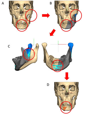 한림대성심병원, 3D 이미지-가상수술 기반 환자 맞춤형 안면골 골절 수술법 개발