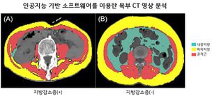 인공지능 기반 CT 체성분 분석으로 루게릭병 환자 예후 예측한다