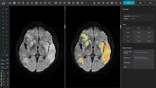 제이엘케이 AI 솔루션, 뇌경색 환자의 25%에서 일주일 이내 뇌경색 부피 감소 확인