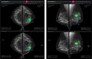 루닛, 美 의료기관에 FDA 승인 '3D 유방암 검출 AI 솔루션' 판매