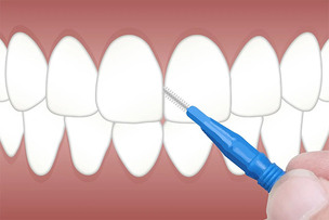 '치간 칫솔' 사용, 잔존 치아 20개 이상일 때 치주염 예방 효과 &uarr;