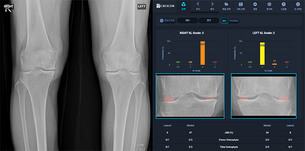 크레스콤, KL 등급 기반 ‘무릎 관절염 심각도 정량화 자동분석 AI’ 의료기기 제조 허가 취득