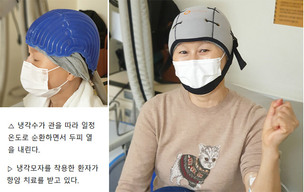 암 치료 후 지속 탈모, 냉각 모자 착용이 예방에 도움