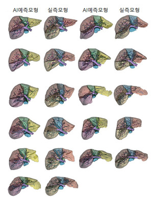 삼성서울병원, 간이식 AI 모델 개발 “공여자 간 크기 및 부피 자동 계산”