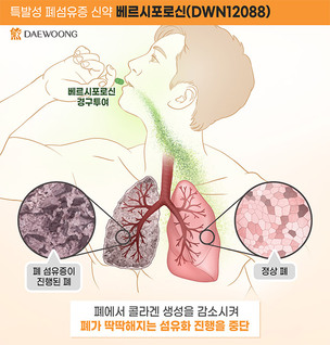 대웅제약, 특발성 폐섬유증 치료제 임상 2상 안전성 검증&hellip;빠른 상용화 기대