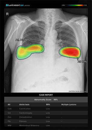 루닛 인사이트 CXR, 글로벌 AI 솔루션 12개 중 최고 결핵 검출 성능 확인