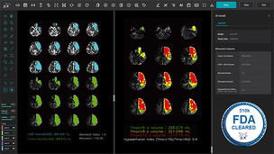 제이엘케이, AI 뇌졸중 솔루션 'JLK-CTP' FDA 510K 승인 획득