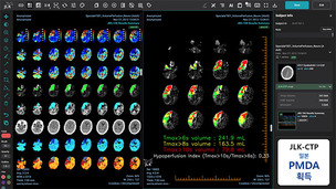제이엘케이, 뇌졸중 솔루션 JLK-CTP 일본 PMDA 인허가 획득
