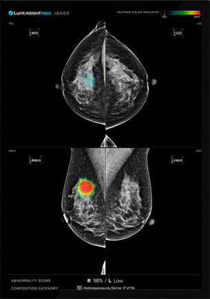 유방촬영술 영상 분석 AI "유방암 발생 최대 6년 전부터 발생 예측"
