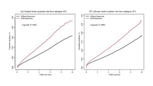 우울증 환자, 관상동맥중재술 후 뇌졸중 및 조기 사망 위험 증가