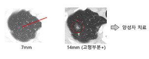 순수 간유리 폐결절, 10년 후 뒤늦게 자란 특성 사례 보고