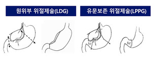 위 절제 최소화한 '유문보존 위위절제술', 조기 위암 치료에 표준 수술만큼 효과적