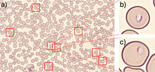 노을, AI 기반 말라리아 진단 솔루션 美 임상 연구 결과 발표