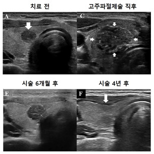 미세갑상선유두암, ‘고주파 절제술’로 안전하게 치료한다…서울대병원, 효과·안전성 확인