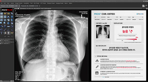 프로메디우스, 골다공증 진단 보조 AI 소프트웨어 식약처 허가 획득