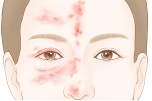 &ldquo;얼굴 수포&middot;눈 충혈 동반되면&rdquo;&hellip;눈대상포진, 방치 땐 실명까지