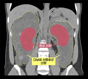 7배 커진 신장도 최소 절개로…서울아산병원, 고난도 로봇 신장이식 성공