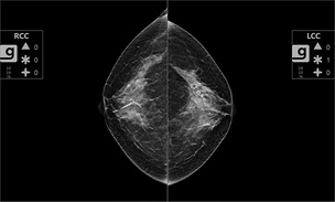 동아대병원, 3D 유방암 판독 보조 솔루션 'Genius AI 2.0' 경남 지역 첫 도입