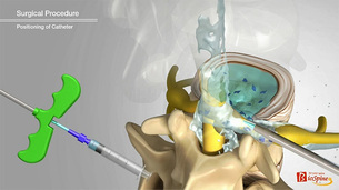추간공확장술, 척추관협착증 통증 완화 및 신경 압박 감소에 활용