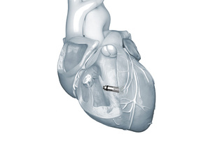 메드트로닉, 무전극선 심박동기 ‘마이크라’ 10년 성과 발표