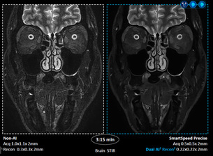 필립스, 듀얼 AI 적용 MR 기술 공개…검사 속도 3배·선명도 80% 향상