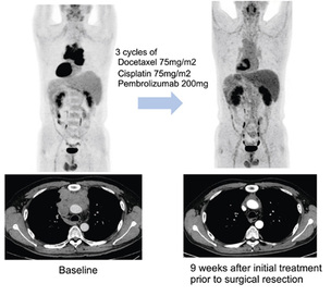 치료 옵션 제한적인 흉선암, 면역항암제 효과 ‘가능성’ 확인