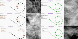 고위험 환자도 가능한 인공와우 수술…국소마취·방사선 없는 기술 검증