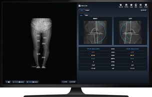 크레스콤, 하지정렬 AI 분석 솔루션 'MediAI-SG' 출시