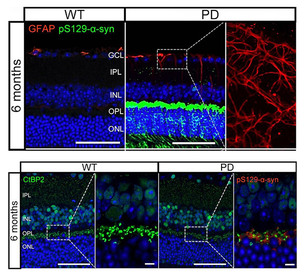 파킨슨병 조기 진단 단서 찾았다&hellip;망막에서 신경 이상 먼저 포착