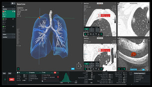 코어라인소프트, 아스트라제네카 스위스와 폐암 AI 공동연구 참여