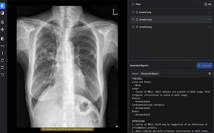 흉부X선 기반 ‘예비소견서 생성’ AI, 식약처 허가